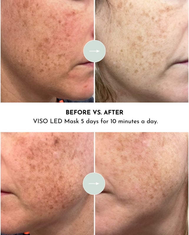 VISO Red Light Therapy Mask | 470 Micro-LEDs | FDA Certified