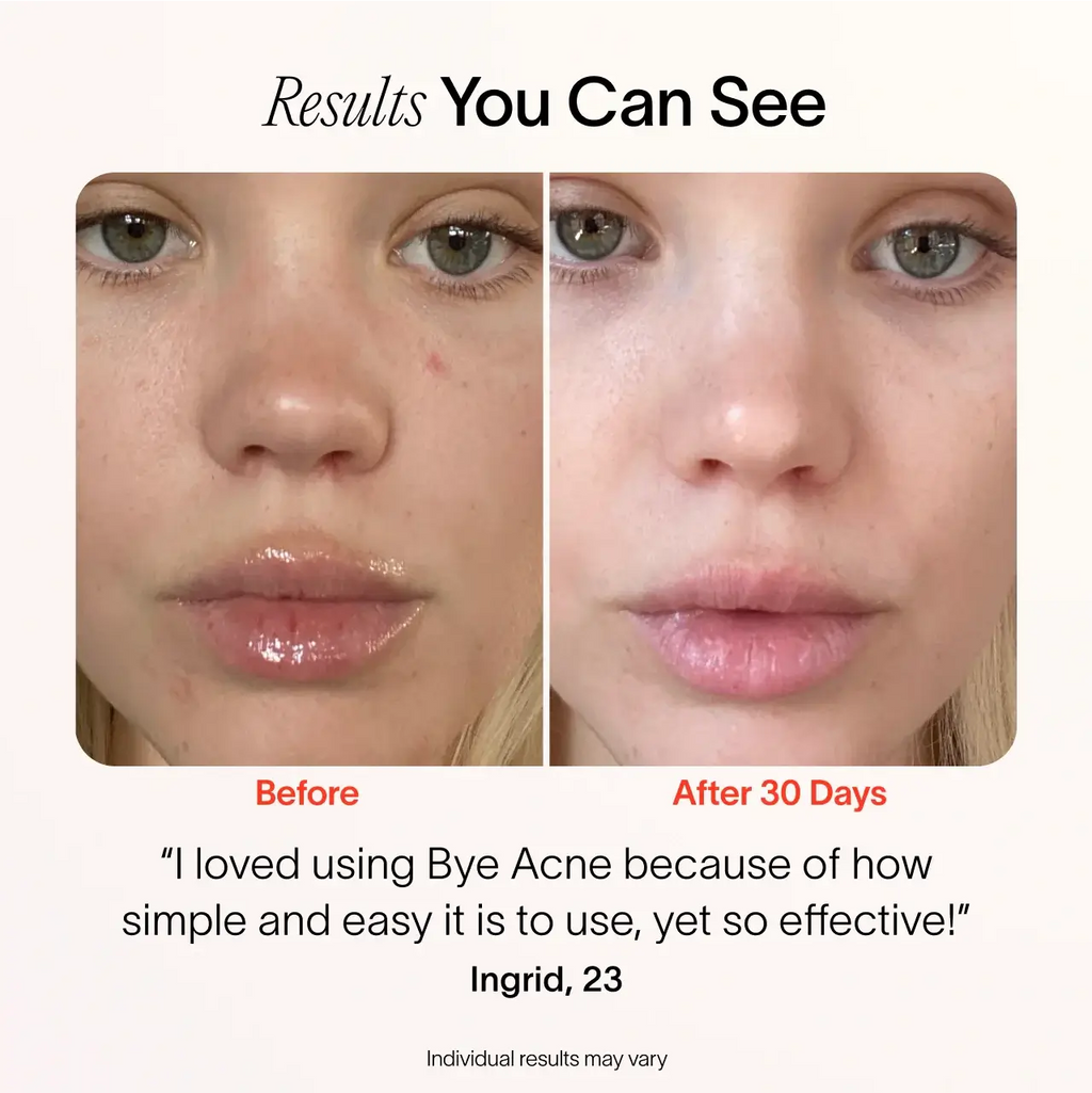 Solawave Bye Acne – 3-Minute Blue & Red Light Pimple Spot Treatment