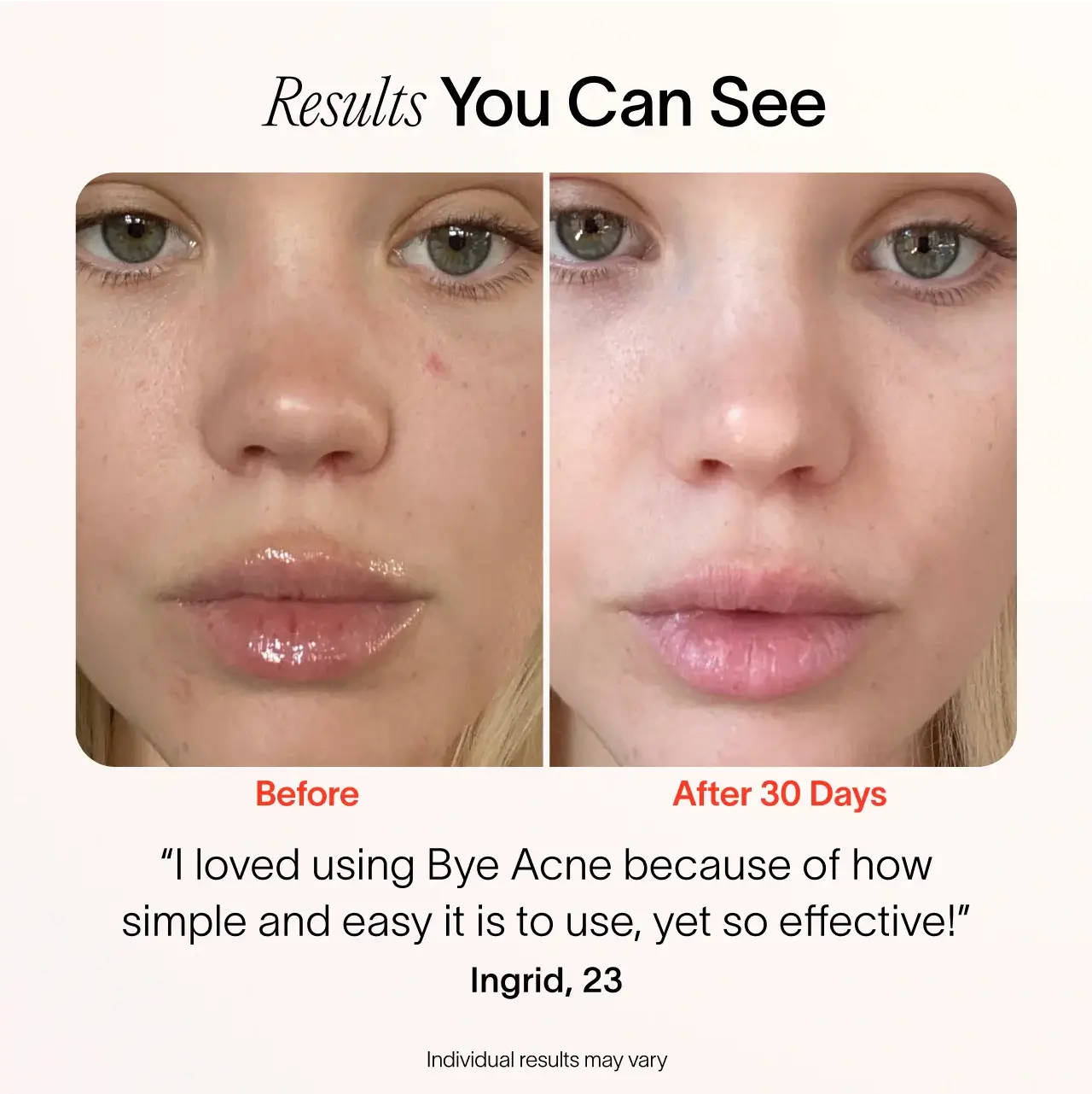 Solawave Bye Acne – 3-Minute Blue & Red Light Pimple Spot Treatment