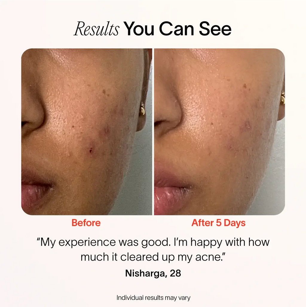 Solawave Bye Acne – 3-Minute Blue & Red Light Pimple Spot Treatment